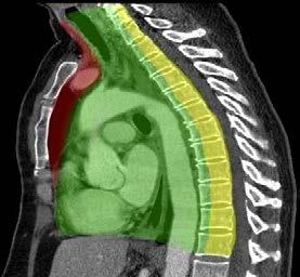 SUMMARY AND KEY POINTS The modern compartment system of the mediastinum on CT is defined by anatomic boundaries, which aids in the classification of mediastinal masses.