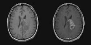 Pseudoprogression Lesion enlargement, evidenced at the first MRI scan in 50 of 103 patients, was