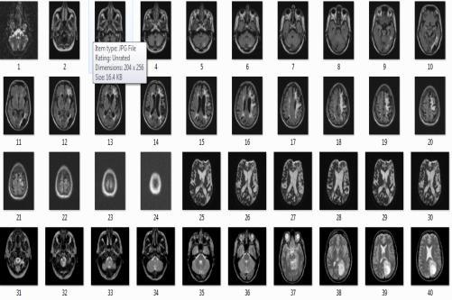 Image recognition and Image compression: - The Database of MRI images is prepared. All the images are converted into one standard size. The colour images are converted into gray image for simplicity.