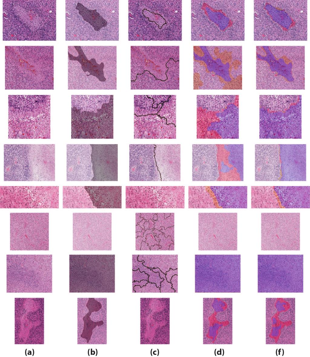 data. The GraphRLM method is an unsupervised method to segment histopathology tissue images. It is not suitable for segmenting necrosis and non-necrosis regions.