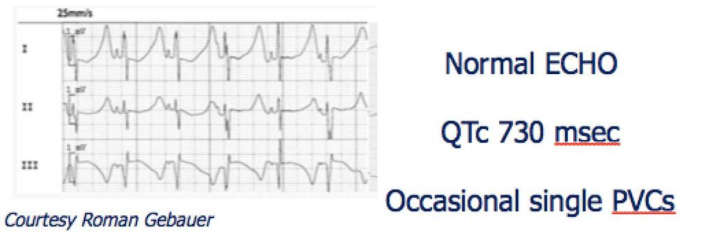 Challenging Case #1 Term newborn at 48 hours noted to have bradycardia (85 bpm) and some respiratory