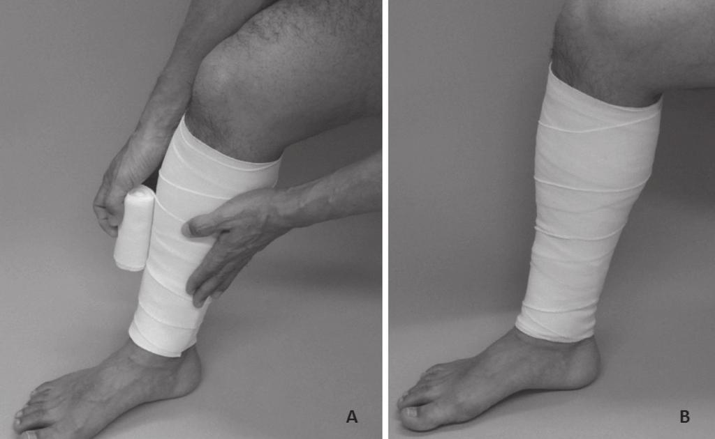 Suehiro K, et al. Fig. 1 Bandaging technique. Elastic bandages are applied to fit around the leg, but without excessive tension.