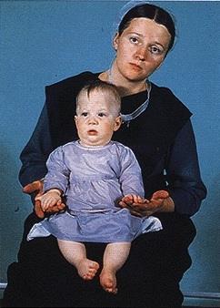Ellis-van Creveld syndrome is an inherited disorder of bone growth that results in very short stature (dwarfism).