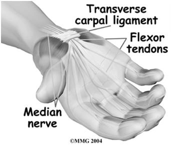 PEARL RADICULOPATHY Carpal tunnel syndrome can mimic a C6,7