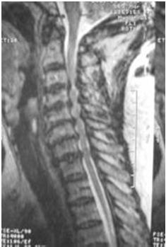 Narrowing of the spinal canal from degeneration Myelopathy