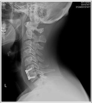 PAST MEDICAL Hx Previous neck surgery