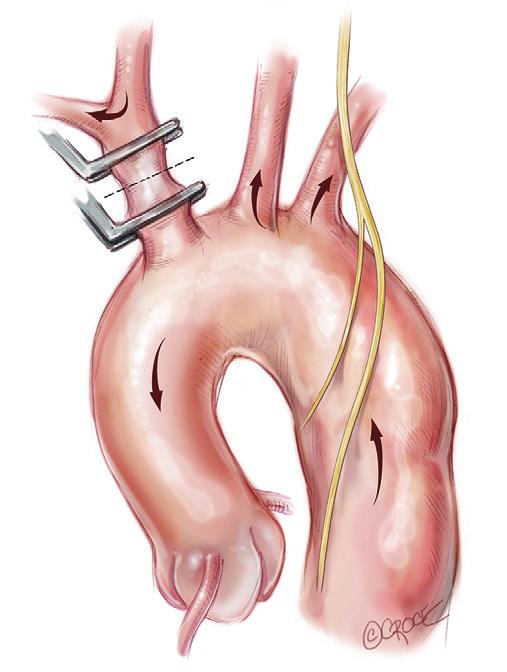 Annals of cardiothoracic surgery, Vol 5, No 3 May 2016 239 A B C D E Figure 2 Following establishment of cardiopulmonary bypass, the branch-first aortic arch reconstruction proceeds as follows: (A)