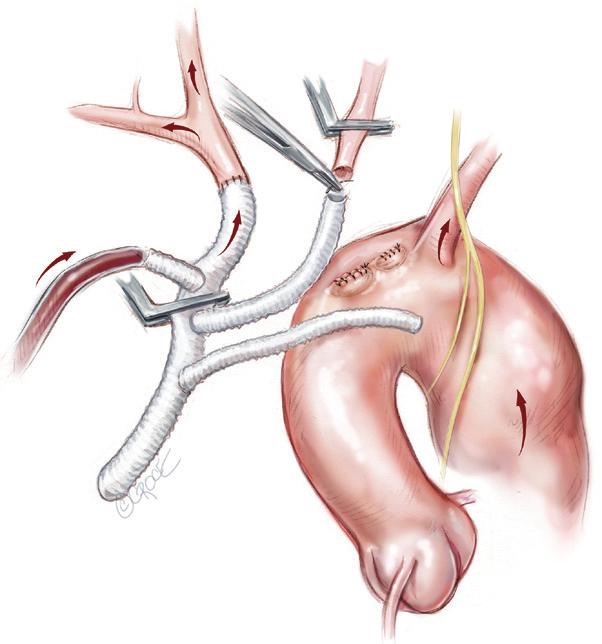 These include collateral channels between; the external and internal carotid arteries; the right and the left carotid arteries; the upper and lower body; and the subclavian and carotid arteries (4);