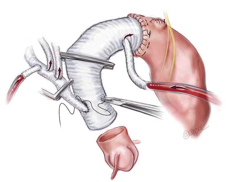 Note that the distal anastomoses can be performed in Zone 2 which is usually better quality tissues, allows improved access to the anastomoses and reduces the risk of recurrent laryngeal nerve injury.