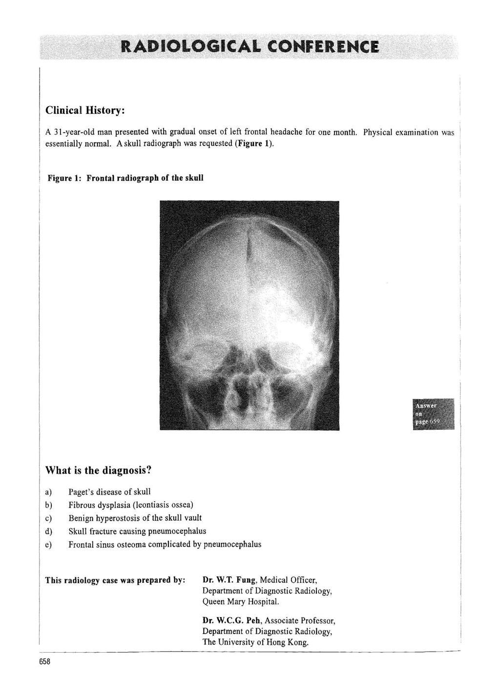 ICE Clinical History: A 31-year-old man presented with gradual onset of left frontal headache for one month. Physical examination was essentially normal. A skull radiograph was requested (Figure 1).