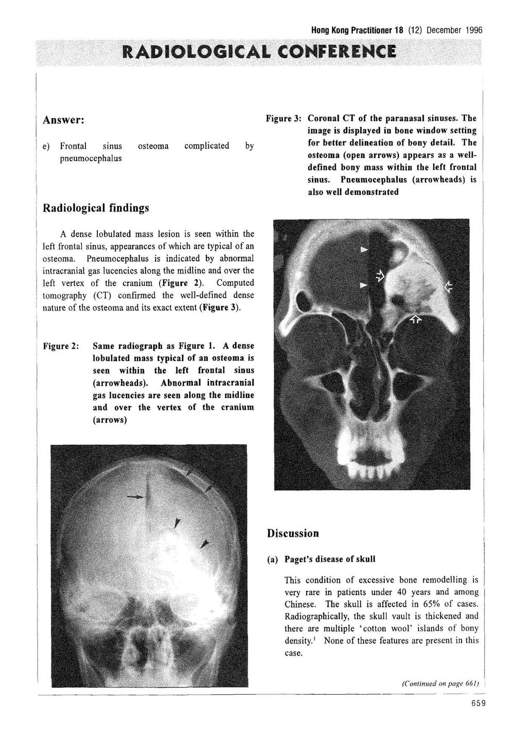 RADIOLOGICAL CONFERENCE Hong Kong Practitioner 18 (12) December 1996 Answer: e) Frontal sinus ; pneumocephalus Radiological findings osteoma complicated by Figure 3: Coronal CT of the paranasal