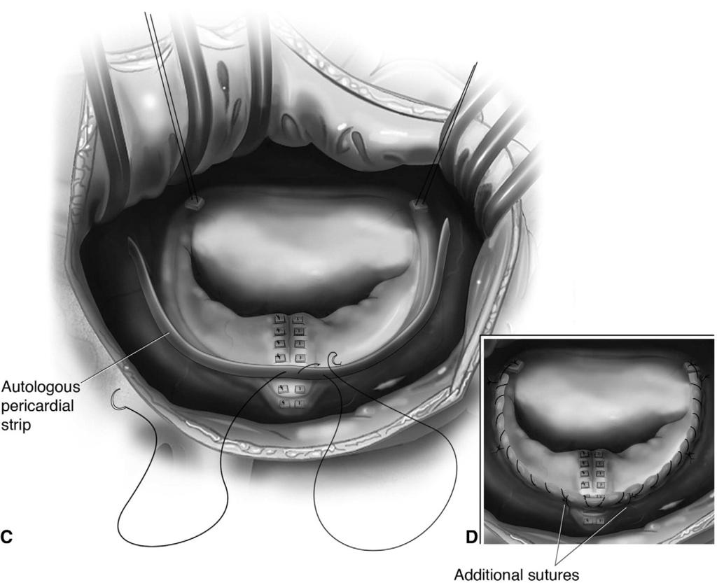 Repair of congenital mitral valve insufficiency 271 Figure 9 Posterior leaflet prolapse from ruptured chordae.