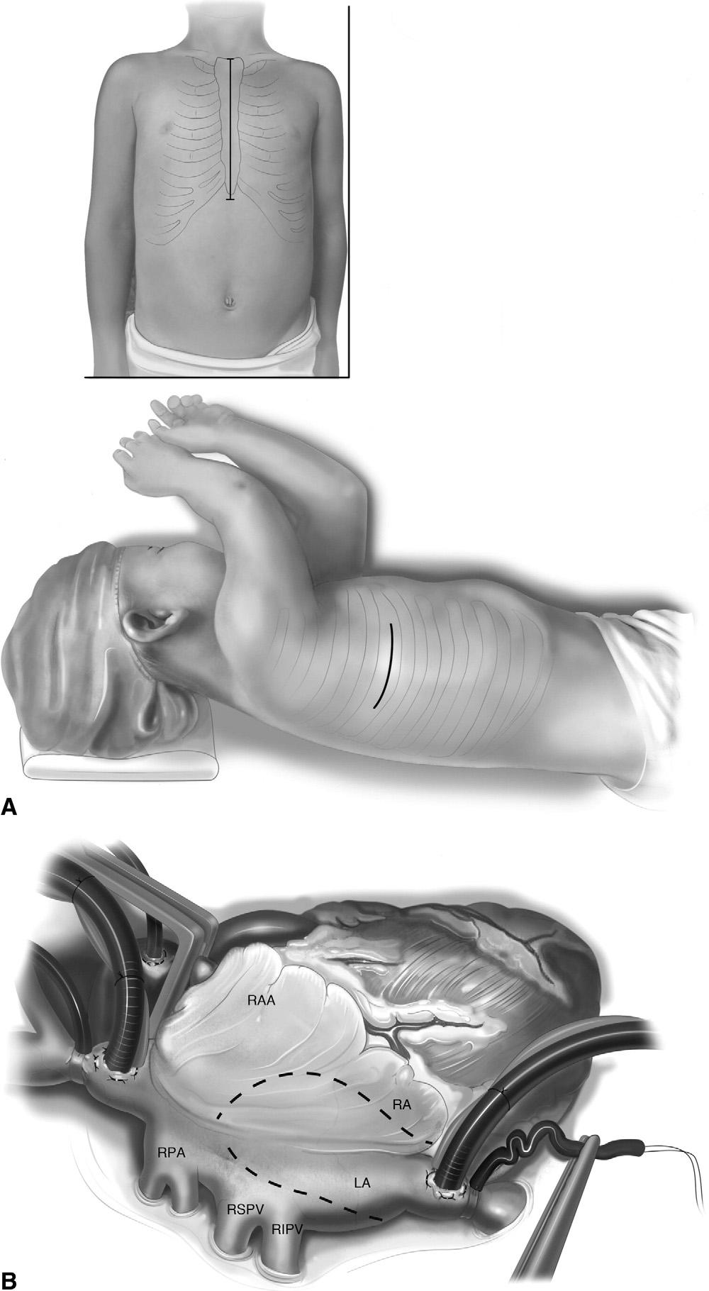 Repair of congenital mitral valve insufficiency 261 Operative Technique Figure 1 (A) Approach.
