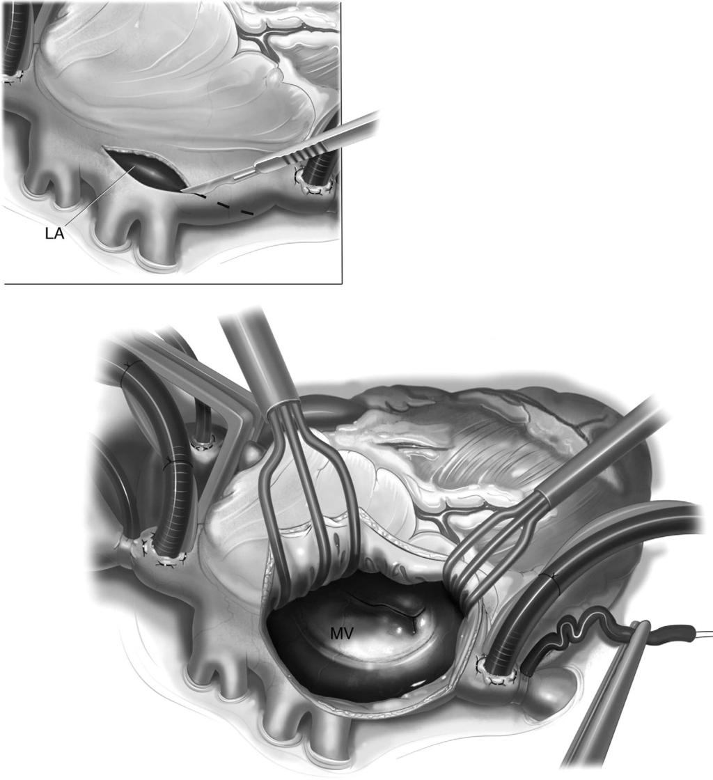 Repair of congenital mitral valve insufficiency 263 Figure 3 (Inset) We usually prefer the left atriotomy approach. With a scalpel, a vertical incision is made along the interatrial groove.