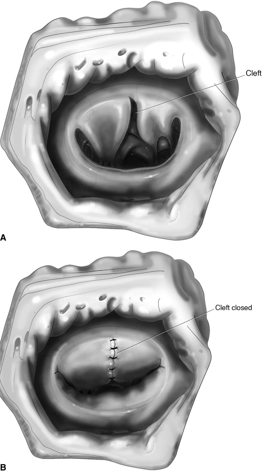 266 R. Hetzer and E.M. Delmo Walter Figure 6 Mitral cleft. (A) A mitral cleft is assessed for the presence of sufficient tissue.