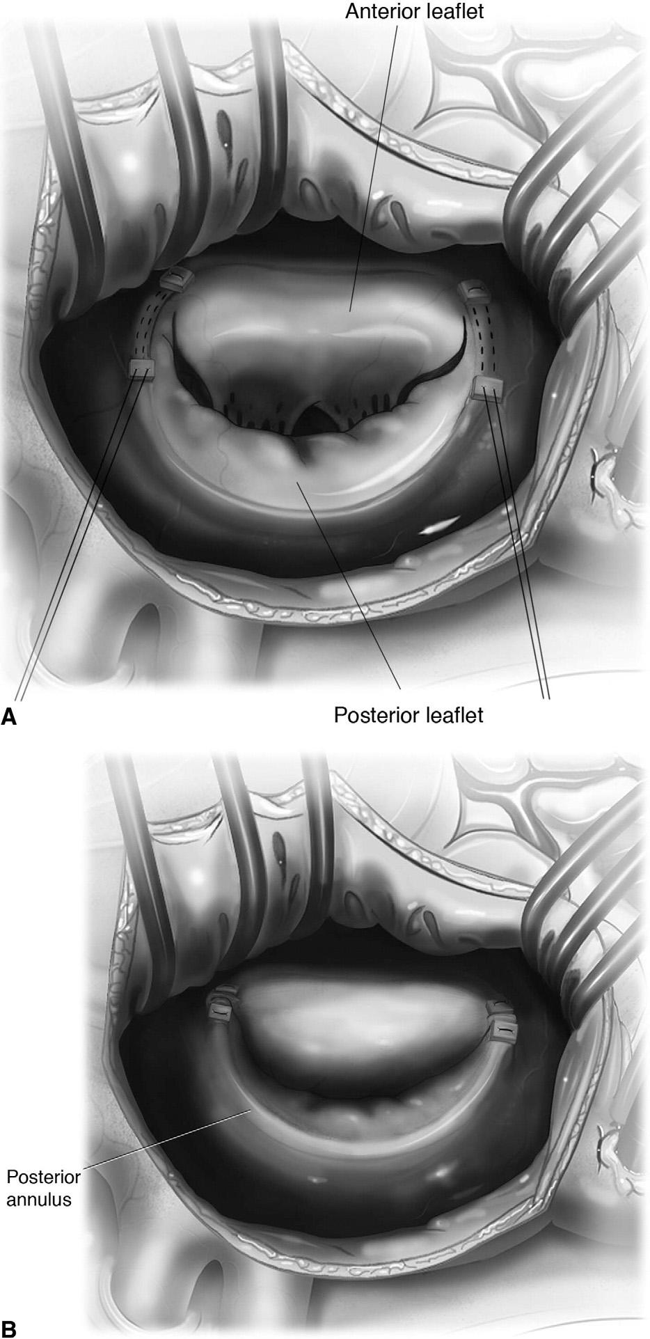 Repair of congenital mitral valve insufficiency 267 Figure 7 Annular dilation in newborns and small infants.