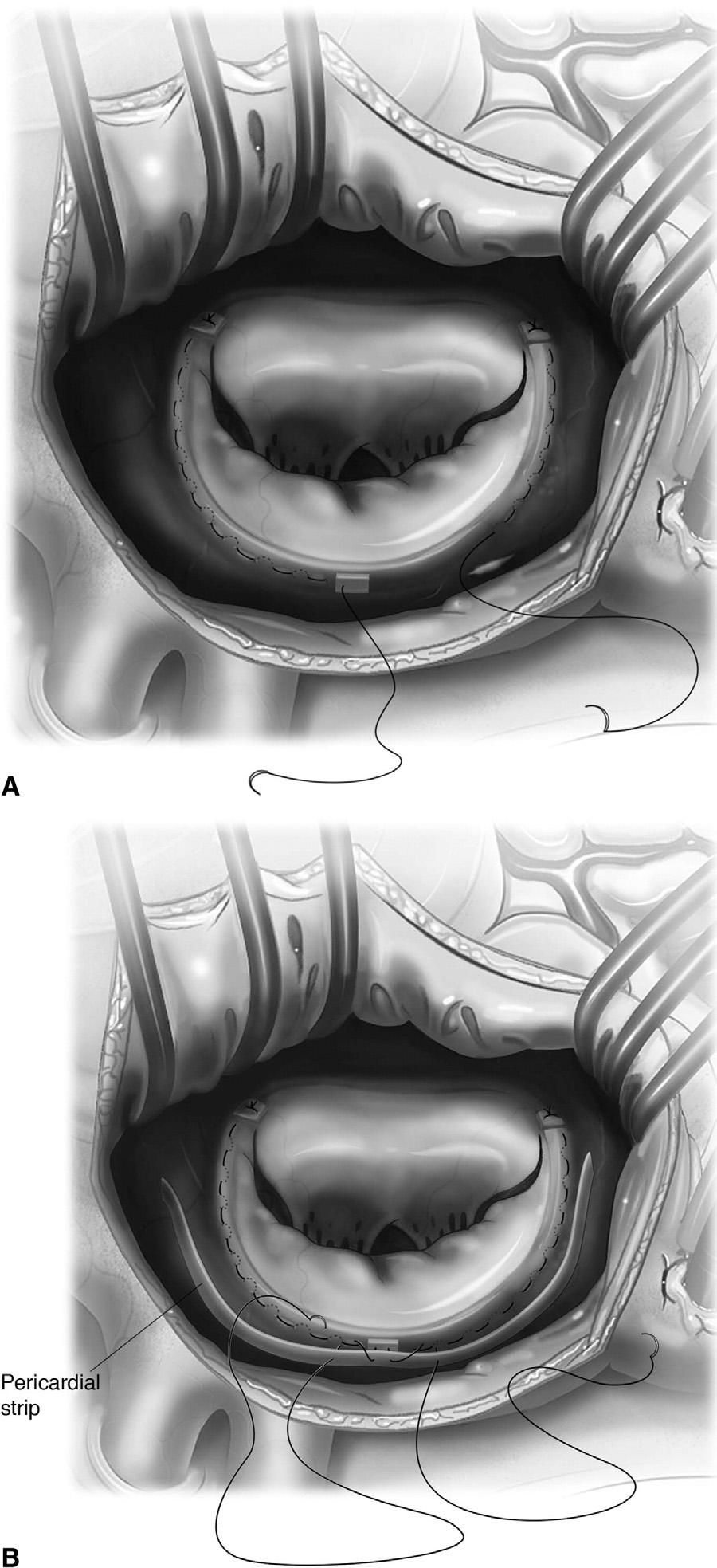 268 R. Hetzer and E.M. Delmo Walter Figure 8 For children and adolescents with severely dilated annulus. A severely dilated annulus is best operated on with a modified Paneth- Hetzer technique.