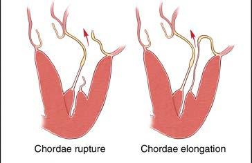 LESIONS - CHORDAE Chordae Lesions: