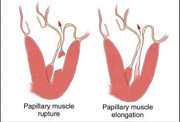 LESIONS PAPILLARY MUSCLE Papillary