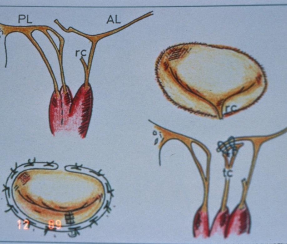 Concomitant, Functional MR Functional Anatomy of Mitral Valve Chordae Tendineae - Primary (marginal): - From pap tip to leading edge - Prevent prolapse during systole - Secondary