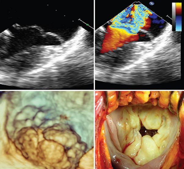 Mitral Regurgitation and Mitral Valve Prolapse Problems associated with the MV result in a leaky valve, in which reverse blood flow occurs across the MV during systole.