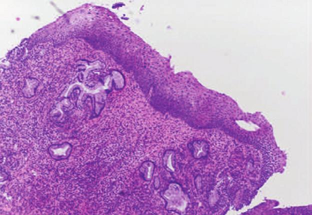 Cervical biopsy with SIL showing partial maturation; some might question the lesion grade (CIN2?).