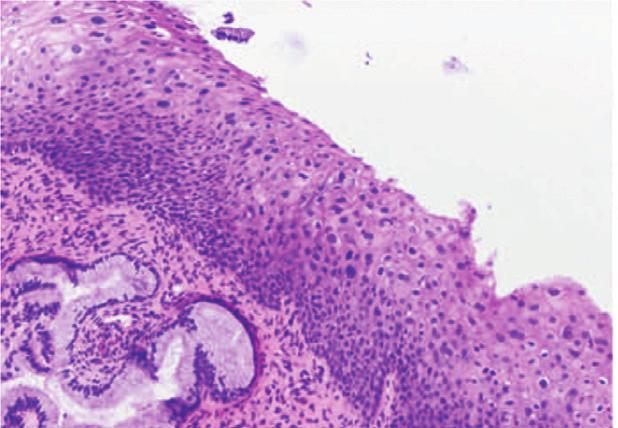 (b) High-power immunohistochemical stain, demonstrating weak, patchy reactivity that starts above the basal layer, a pattern that should be interpreted as negative, which, in this case, supports the
