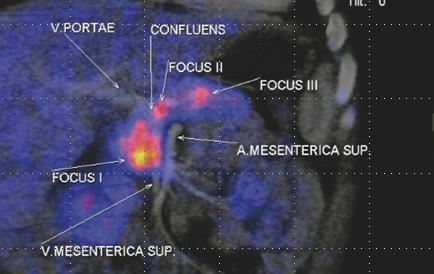 Position and size of focal lesions? Size and position of focal lesions are accurate in 71 88% (Treglia, Pediatr.