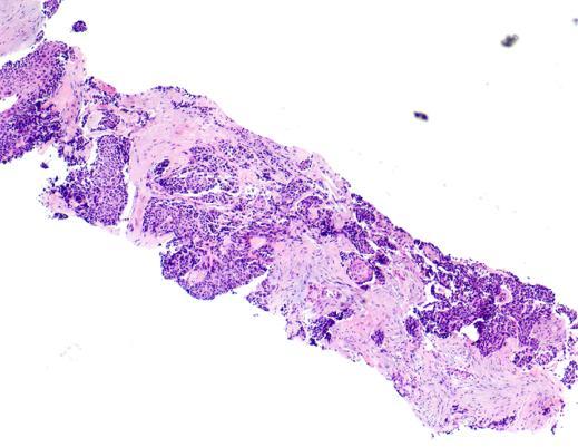 Resected Specimen Core Biopsy