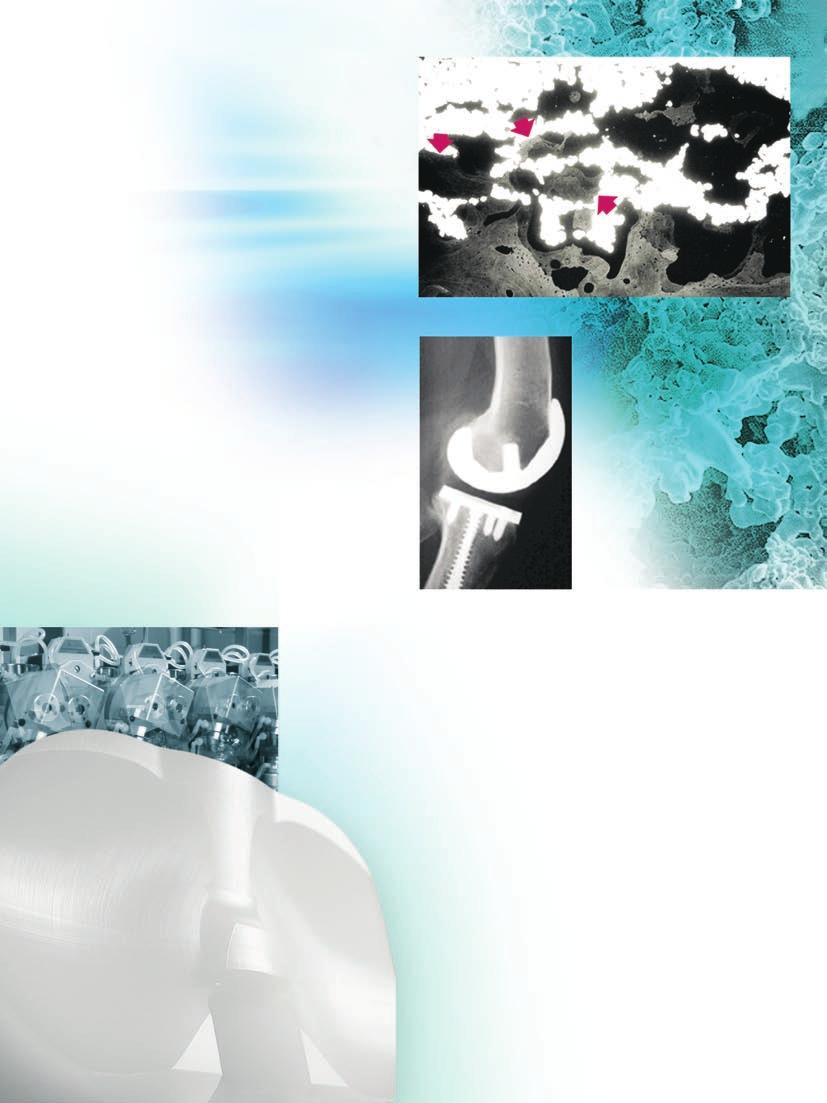 CSTi Porous Coating Structurally similar to human bone CSTi porous coating combines the excellent biocompatibility of titanium with an optimal structure for bone ingrowth.