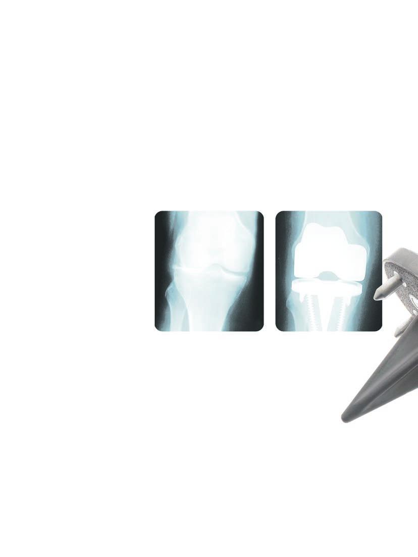 Natural-Knee II System Reproducible. Predictable. Results. Since 1985, the Natural-Knee II System has been used successfully to treat over 450,000 patients.