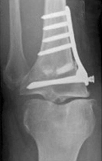 OWHTO was performed with a 9-mm opening biplane osteotomy filling with β- tricalcium phosphate. HKA improved from 4 of varus to 5 of valgus.
