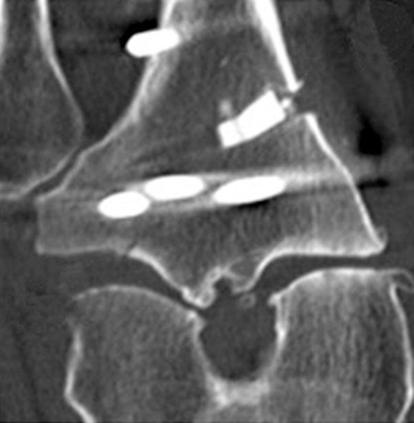 Type III fracture was treated with low intensity pulsed ultrasound to accelerate bone healing without weight bearing.