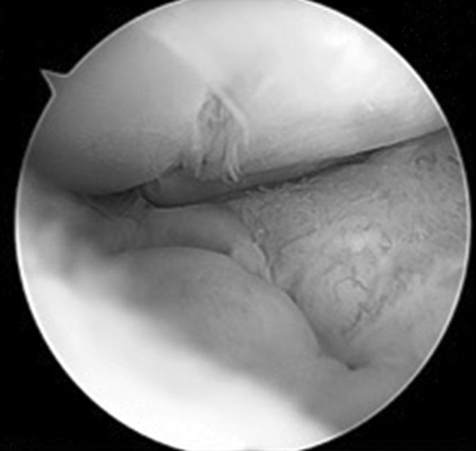 Two months after surgery, the center pin at the proximal plate backed out (Fig.