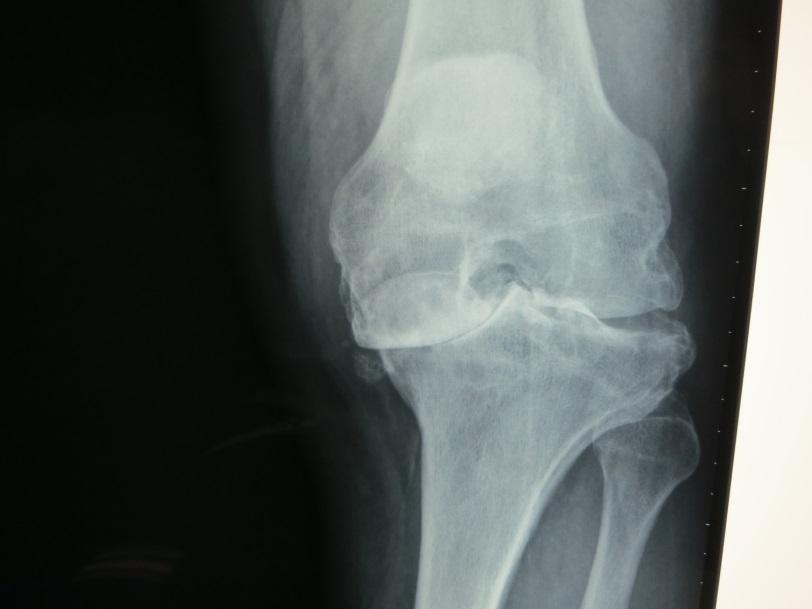 Bone stock loss Options Cut lower on tibia Leave in