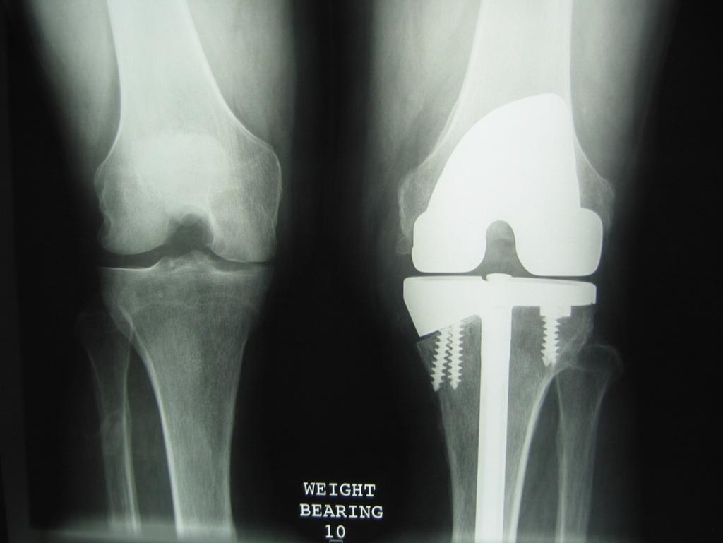 07/02/14 Bone stock loss Augment Wedge tibia Flat augment