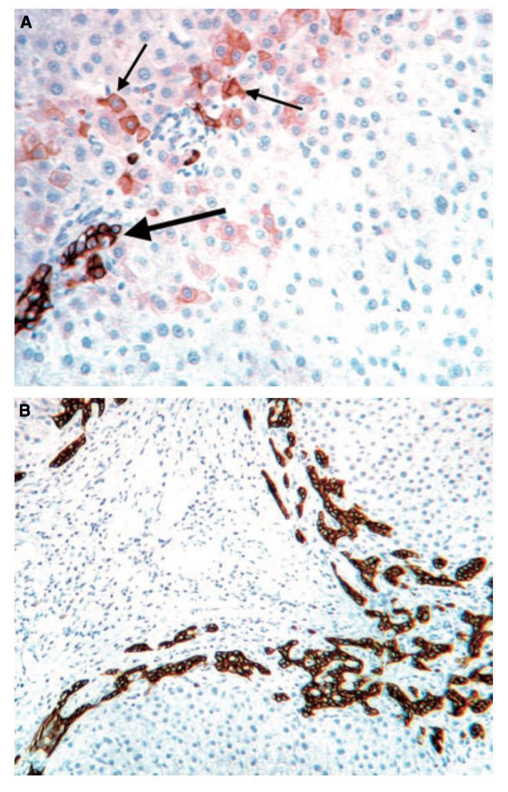 A, Early primary biliary cirrhosis showing a surviving native bile duct (large arrow) and CK7+ periportal cells with an intermediate hepatobiliary phenotype (examples indicated with small arrows)