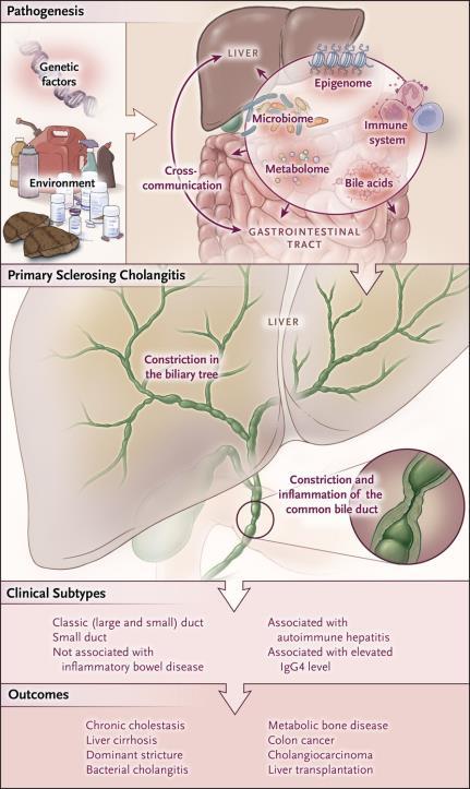Pathogenesis, Clinical Subtypes, and Outcomes of Primary Sclerosing Cholangitis.