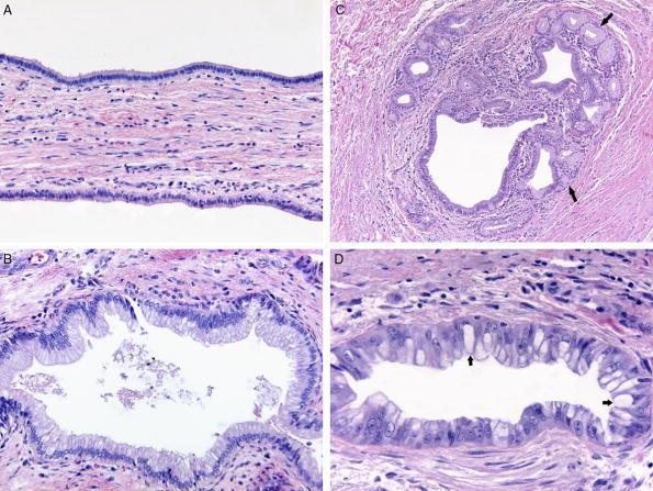 American Journal of Surgical Pathology. 34(1):27-34, January 2010. FIGURE 1. Bile duct metaplasia. A, Normal bile duct epithelium with cuboidal and low columnar cells. B, Mucinous metaplasia.