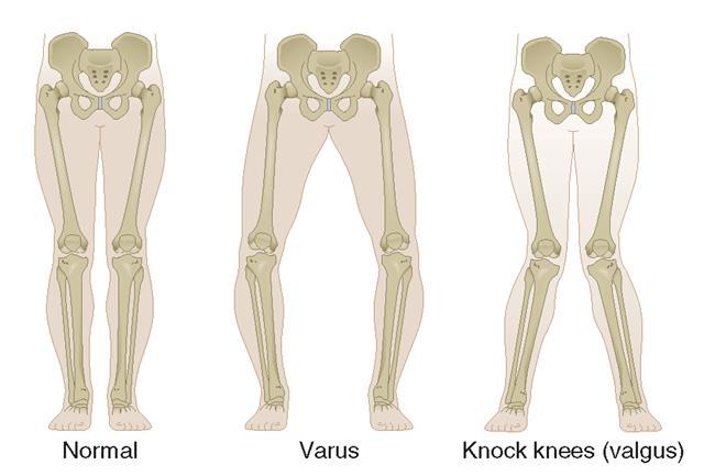 Inspection Knee Evaluation Physical Exam» Alignment varus