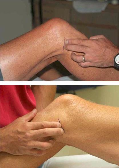 Palpation Knee Evaluation Physical Exam» Point tenderness»