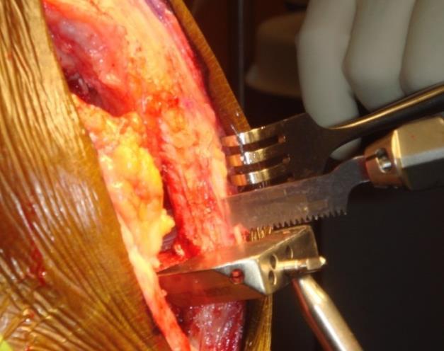 PATELLAR TENDON SPLIT Trans-patellar tendon approach for vertical tibial resection