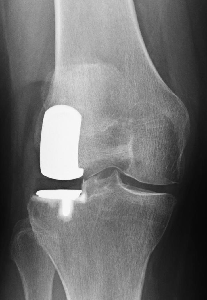 LATERAL UKA Less than 1% of all knee arthroplasties Technically more difficult Less reproducible Complex kinematic