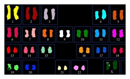 Spectral Karyotyping (SKY) Photo: Autism Spectrum Disorder in a