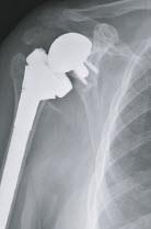RSA Complications Instability 5% (78 studies 2006-2015, 4,124 shoulders) Glenoid failure 7.2% Baseplate failure Glenosphere Disassociation Bhosali et al, J Bone Joint Surg Am.