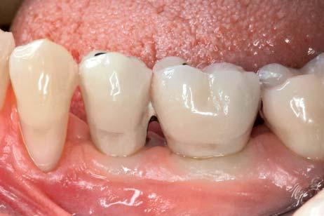 Note the ischemia on the gingival tissues due to compression from the proper emergence profile of the prosthesis. implant placement (Fig 4).