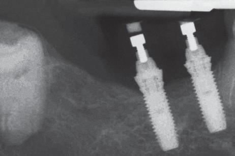 a b c d Fig 6 Radiographs of (a) machined implants at at baseline, (b) machined implants at 12 months, (c) TiO implants at baseline, and (d) TiO implants at 12 months. measured.