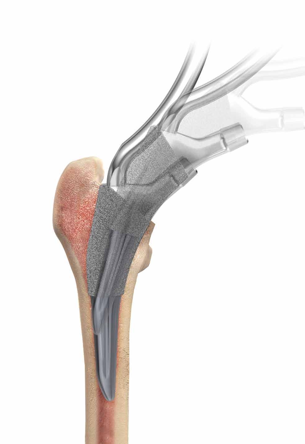 Preserving the natural anatomy Soft tissue preservation Bone preservation Optimized length, contoured distal tip and reduced lateral shoulder enhance stem insertion through the anterior and