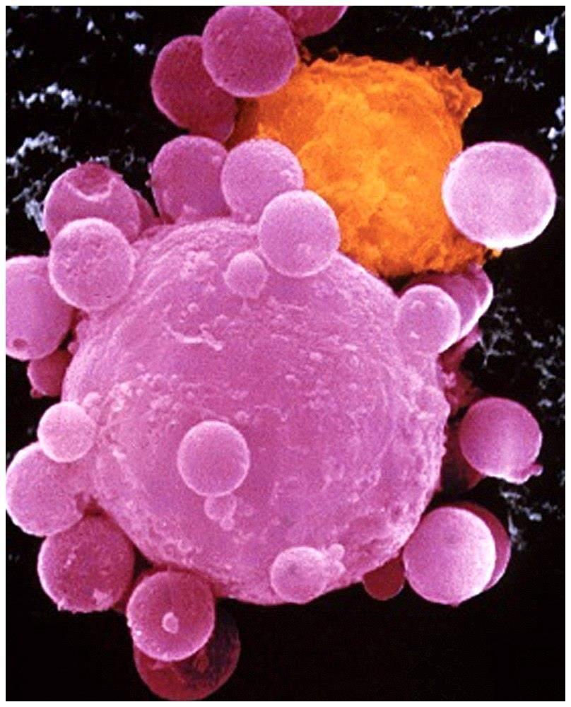 FasL (Fas receptor ligand) is used by cytotoxic T lymphocyte to kill cancer cells Death-receptor pathway Colorized scanning electron micrograph