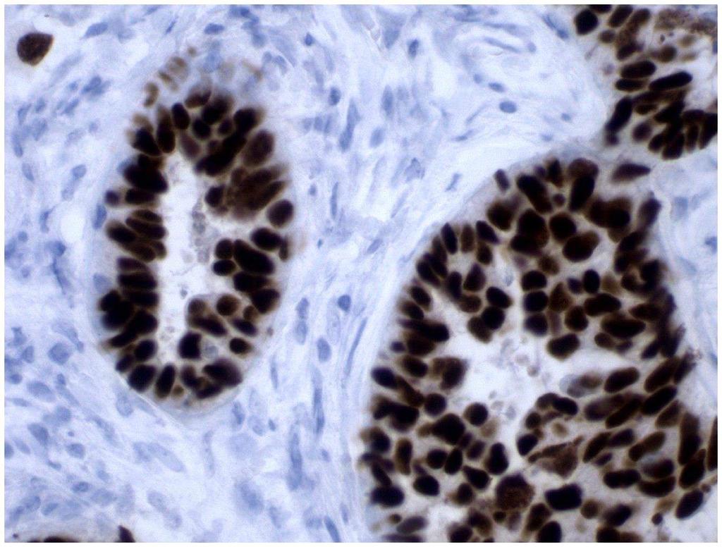 SV40-transformed cells express large T antigen in nuclei SV40 transformed human mammary epithelial cells (MECs) normal stroma cells Tumor